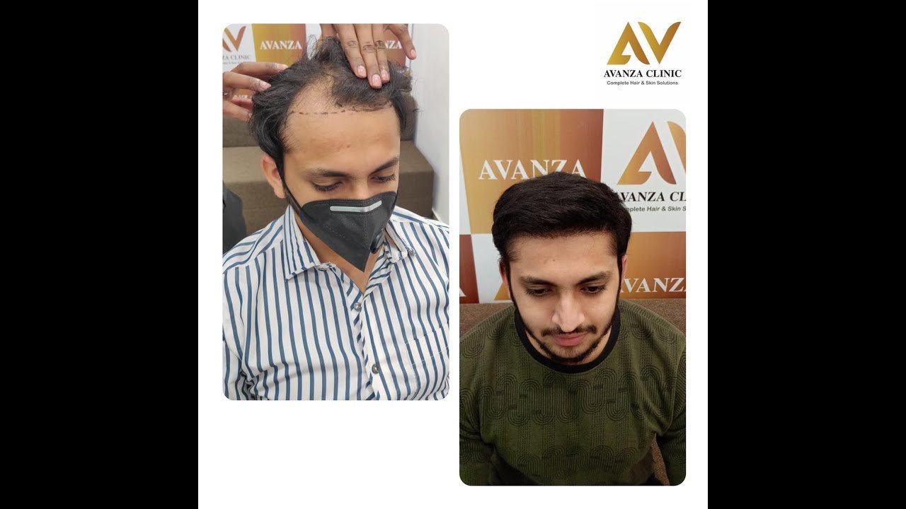 hair transplant youtube video 4