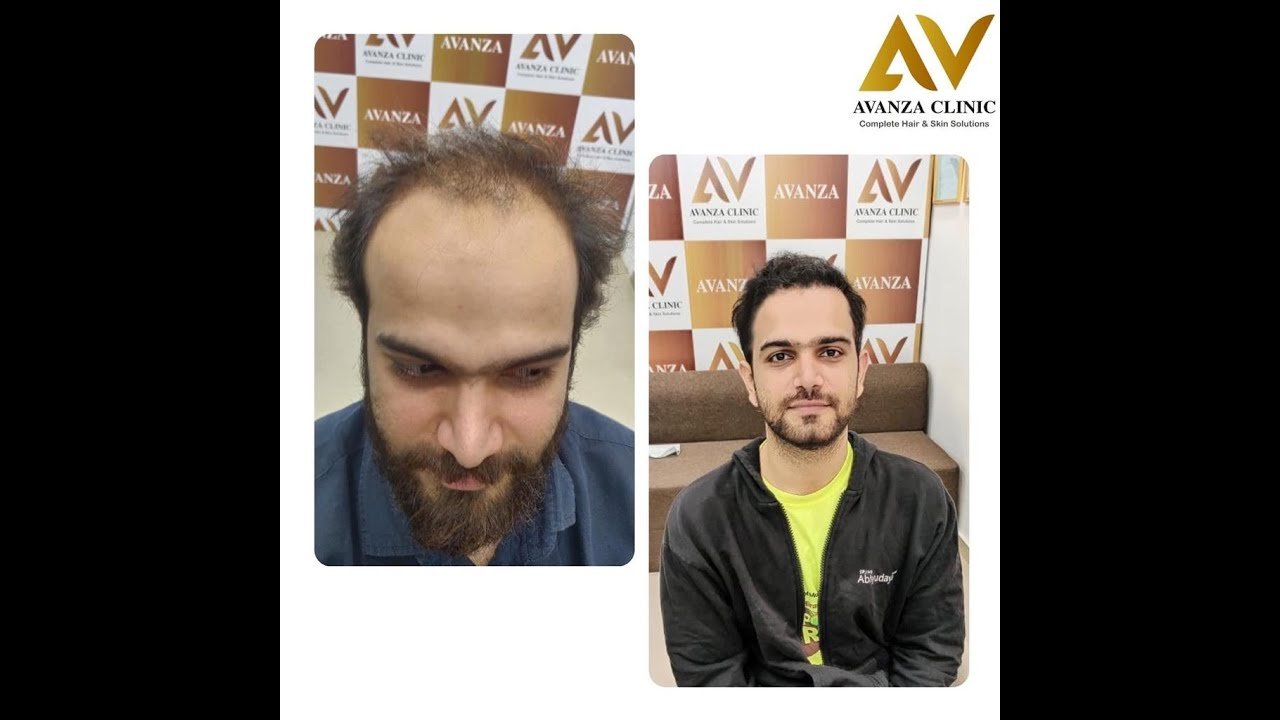 hair transplant youtube video 5