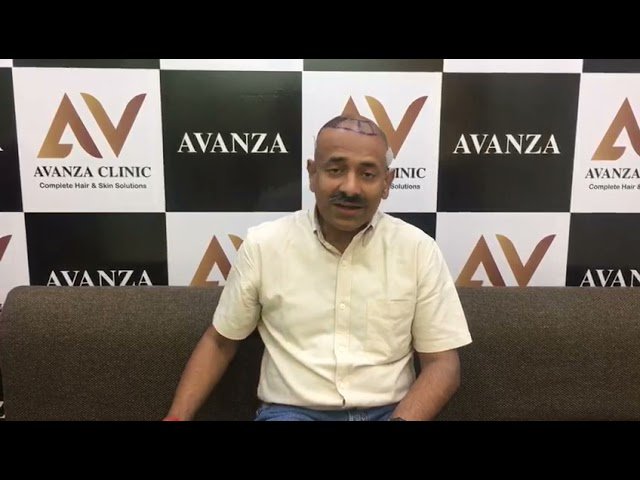 hair transplant youtube video 6