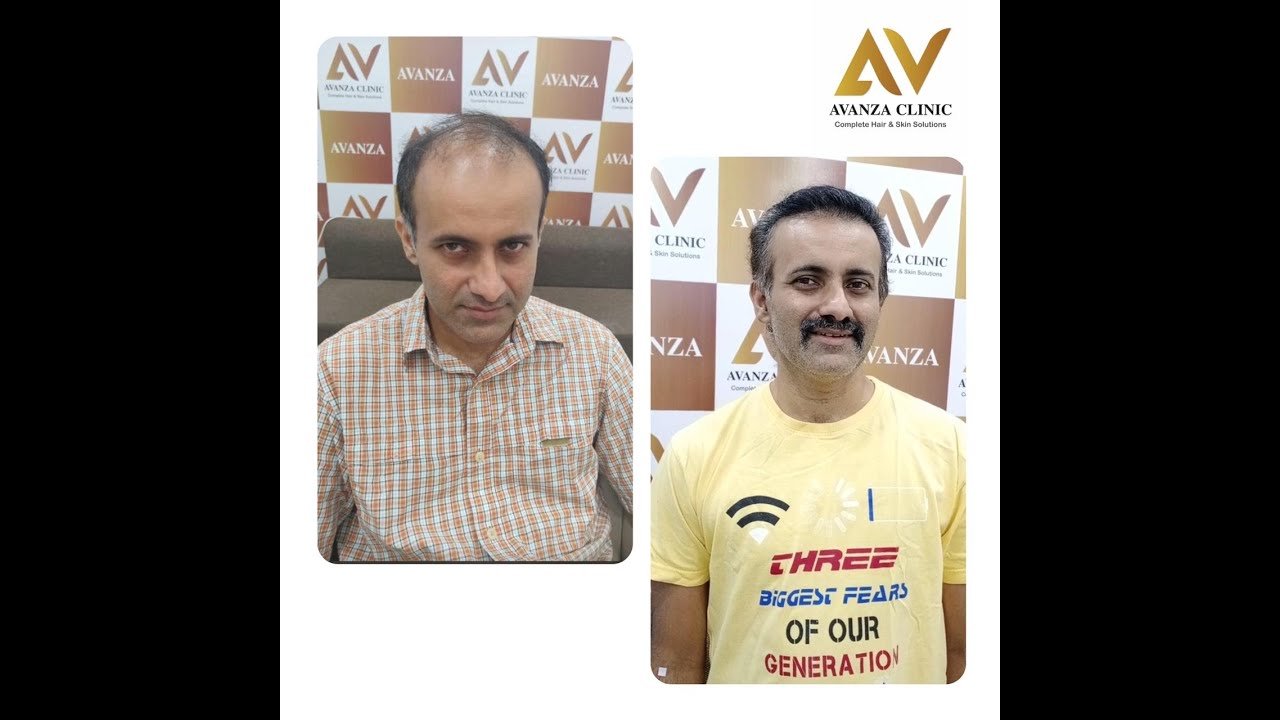 hair transplant youtube video 7