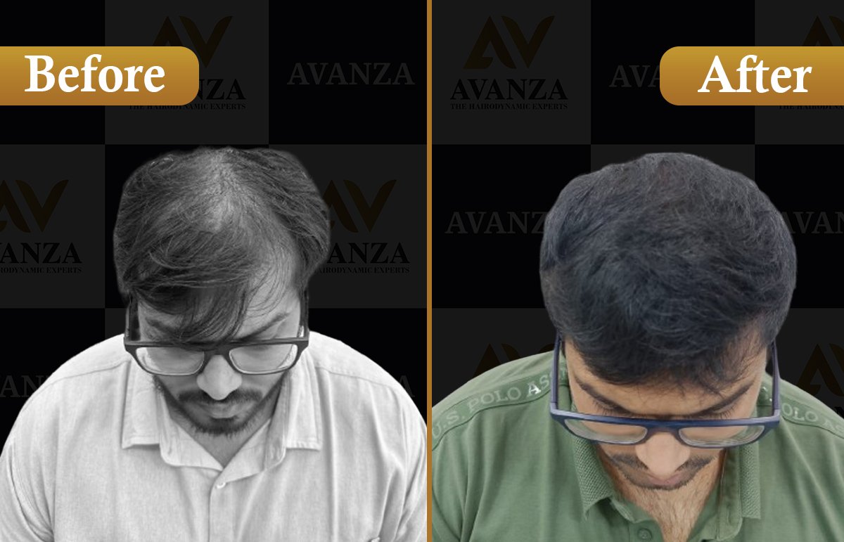 Hair Transplant result1
