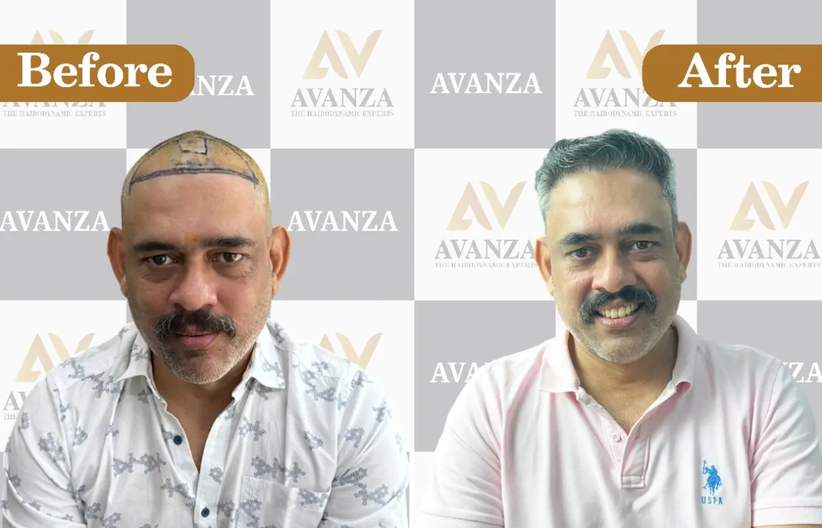 Vineet Sharma Hair Transplant result