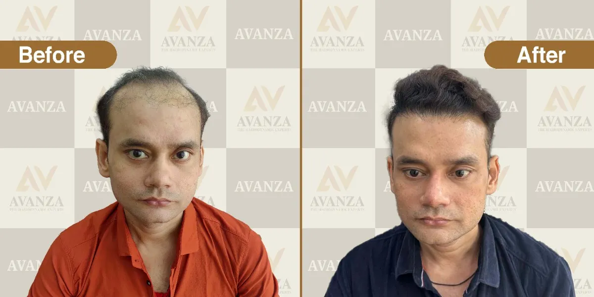 Hair restoration results