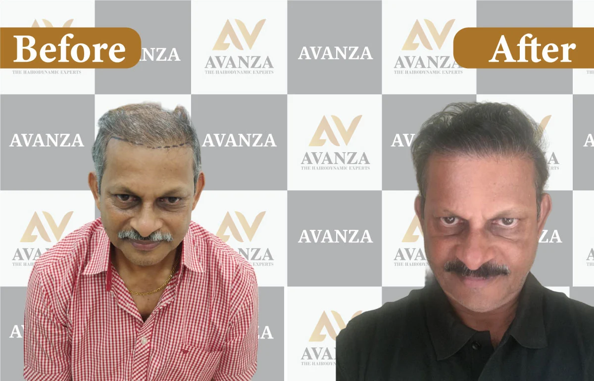 Lalchand Rajput Hair Transplant result
