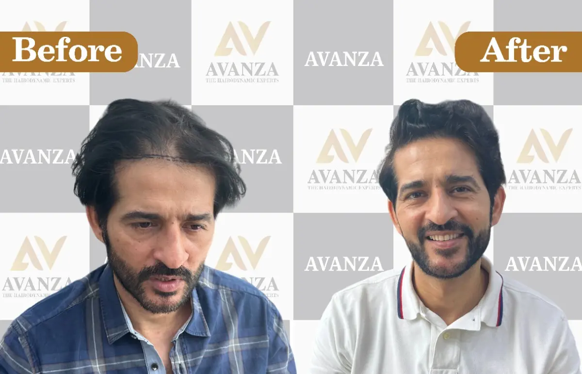Hiten Tejwani Hair Transplant result
